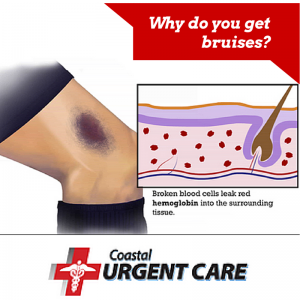 Bruise infographic