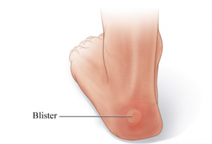 animated blister on foot image