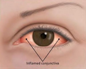 Conjunctivitis Example Drawing