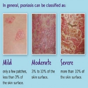 Psoriasis severity level example images