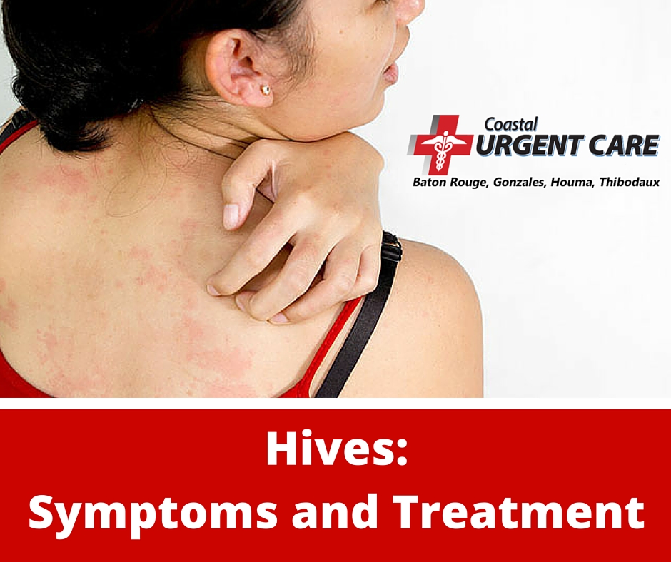 Woman itching back, text reading "Hive: Symptoms and Treatment"