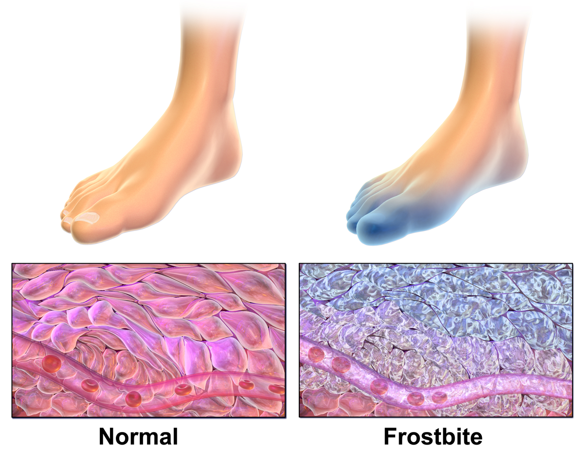 Animated 3D foot frostbite example