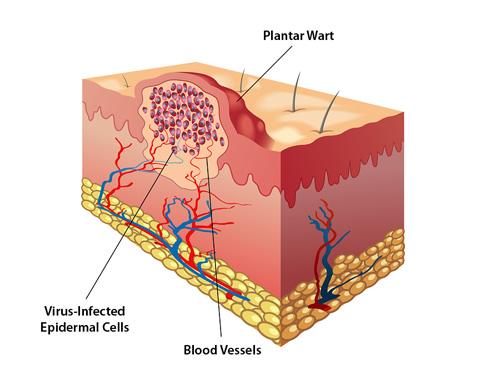 medical 3D image of wart internal formation