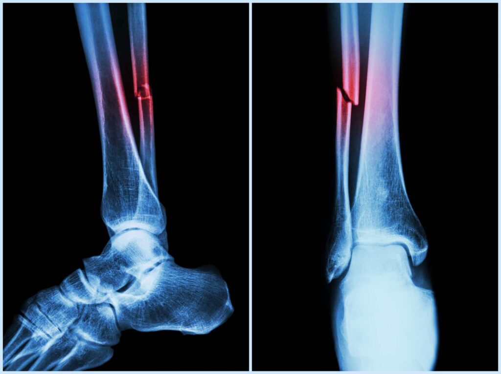 x-ray of broken bone
