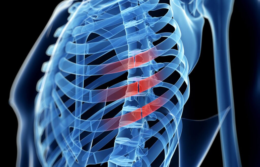 broken rib x-ray