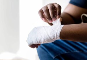 how to treat a burn