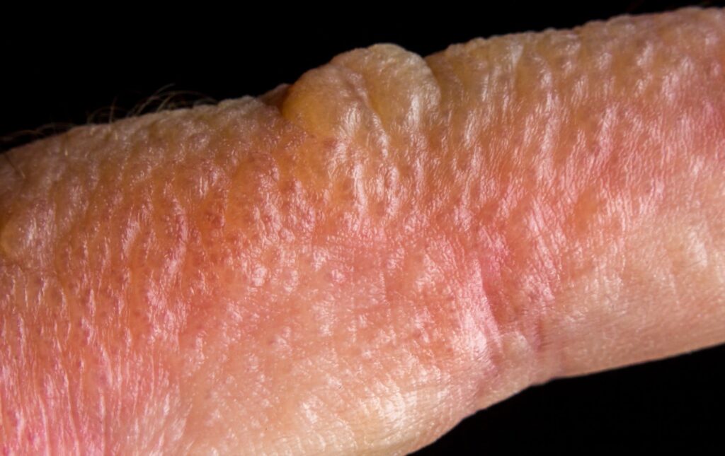 poison ivy rash