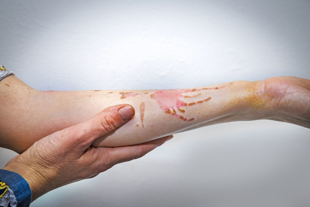 when to seek medical attention for a burn