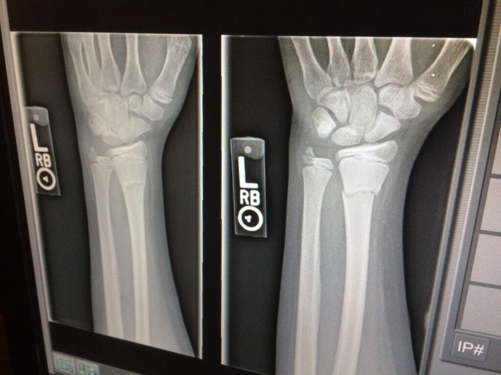 how to treat a broken bone