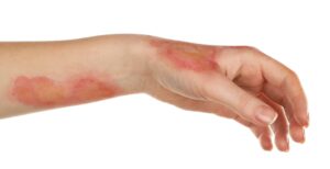 Urgent Care for an Infected Burn