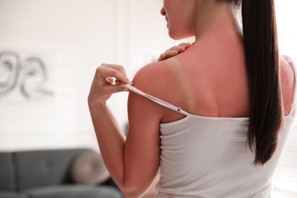 A woman with a sun burn is facing away from the image, pulling down the strap on her white tank top to assess her burn.