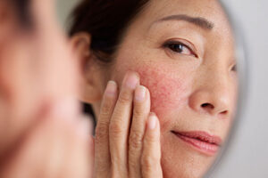 Asian woman examining facial redness in mirror, touching cheek with concerned expression, demonstrating rosacea skin condition