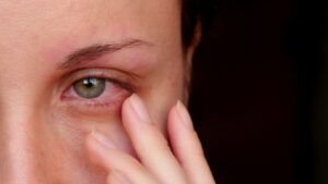 Young woman revealing red, irritated eye.