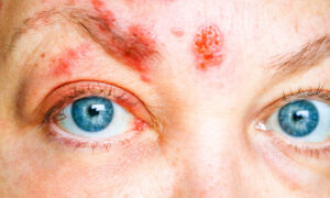 Woman's face showing shingles rash with red blistering lesions around the right eye and forehead.