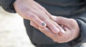 Close-up of a person's hand displaying a bruised fingernail.