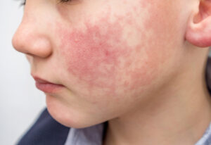 Young boy's face showing red, flushed cheeks indicating possible diathesis, enterovirus infection, or allergic reaction with visible skin redness