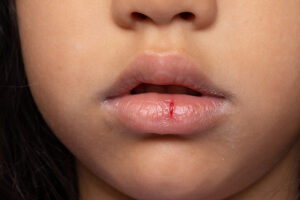 Close-up of cracked, chapped lips with visible fissures and blood, showing severe dehydration or injury