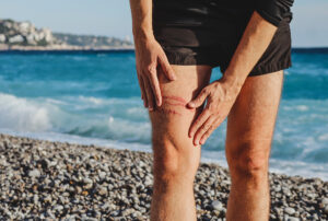 Red welts and linear marks from jellyfish sting on person's thigh on sandy beach