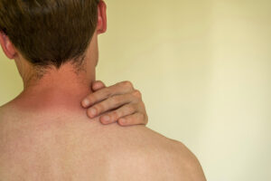 Back view of a man holding his neck; his neck is red from a rash